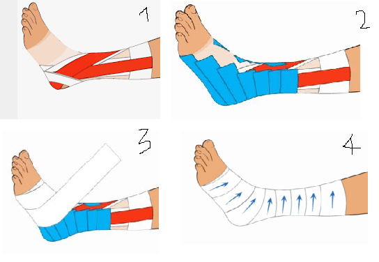 Comment faire un strapping de la cheville